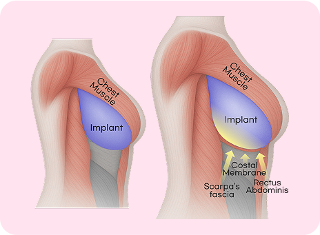 No worries about implant displacement