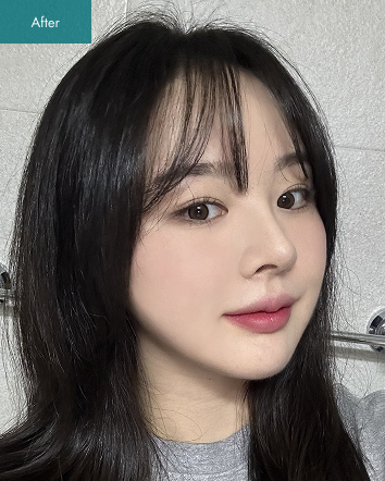 After - 3 Types of Facial Contouring, Nose