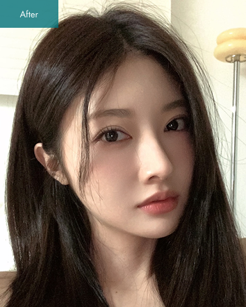 After - Square Jaw Surgery, Revision Rhinoplasty