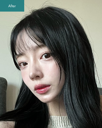 After - Square Jaw Surgery, Cheekbone Reduction, Nose