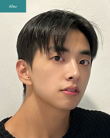 After - Mini V-line Surgery