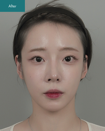 After - Cheekbone Reduction
