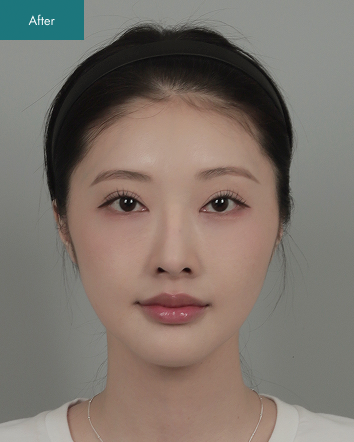 After - Eye Surgery, Nose