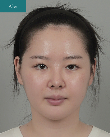 After - Full Facial Contouring