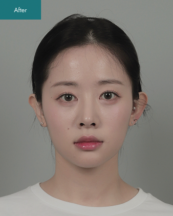 After - Jaw Reduction, Nose