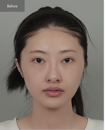 Before - Square Jaw Surgery, Revision Rhinoplasty