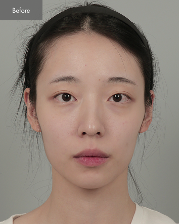 Before - Square Jaw Surgery, Cheekbone Reduction, Nose