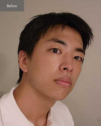 Before - Mini V-line Surgery