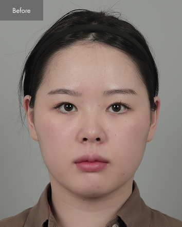 Before - Full Facial Contouring