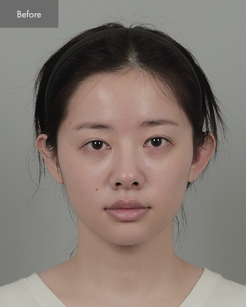 Before - Jaw Reduction, Nose