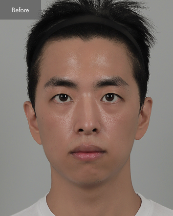 Before - V-line Surgery, Cheekbone