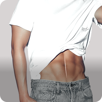 Male Abdominal Surgery