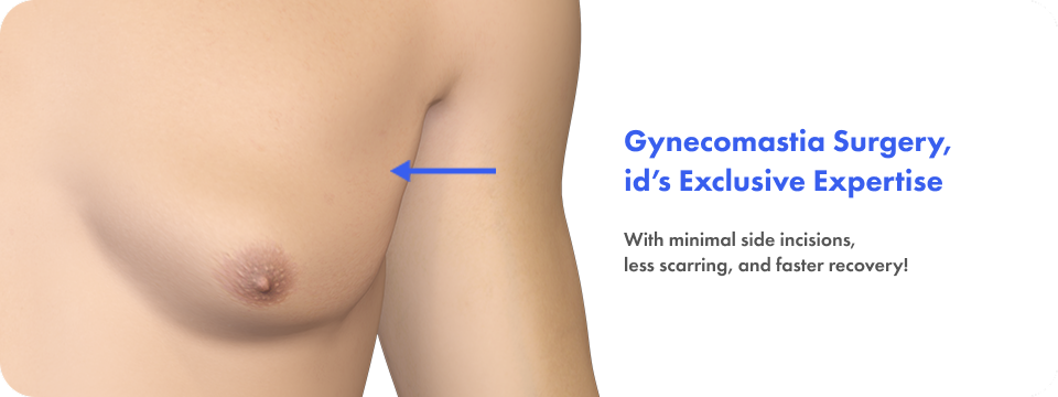 Gynecomastia Surgery, id’s Exclusive Expertise With minimal side incisions, less scarring, and faster recovery!