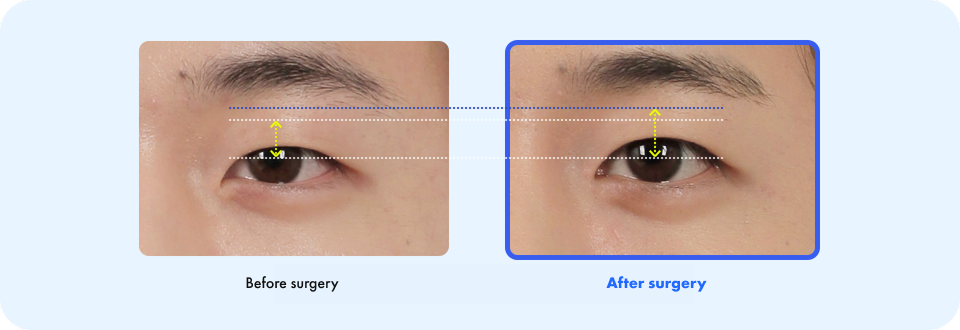 Before surgery After surgery