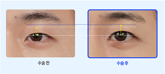 Before surgery After surgery