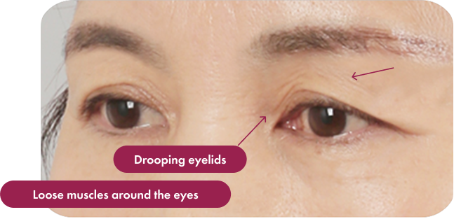 Drooping eyelids Loose muscles around the eyes