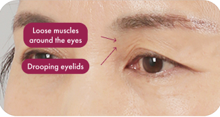Drooping eyelids Loose muscles around the eyes